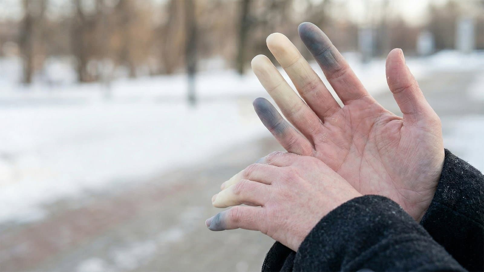 Raynaud syndrome